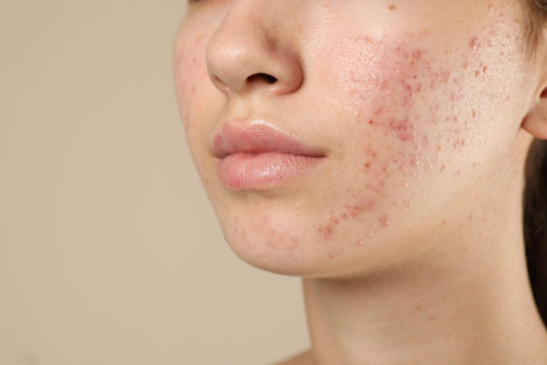 Understanding Acne: Causes, Treatments & Prevention